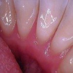 Deep Scaling and Root Planning (lingual)(after)