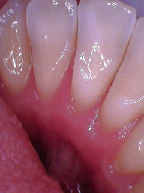 Healthy Smiles Program