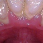 Deep Scaling and Root Planning (lingual)(before)