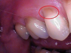 Toothbrush Abrasion