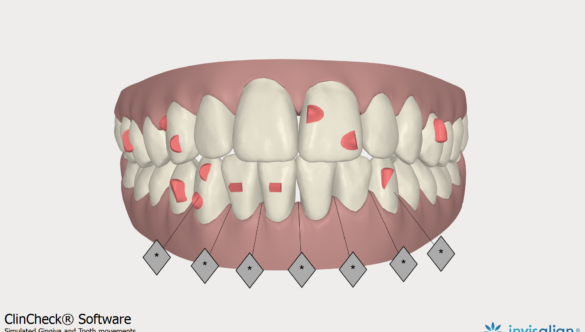 Invisalign Orthodontic Records and ClinCheck