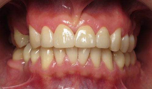 What do Zirconium Crowns look like?