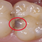 Decay can even form under a filling.