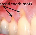 Gum Graft Before Photo by Dr. Bernard W. Murray.
