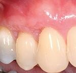 Gum Graft After Photo by Dr. Bernard W. Murray.