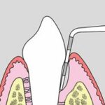 Periodontal probe showing a pocket forming between the tooth root and the gums.