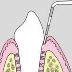 Periodontal probe of healthy gums.