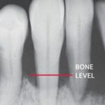 X-ray showing periodontal bone loss.