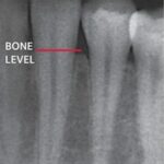 X-ray showing supporting bone.