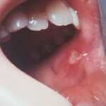 Canker Sore