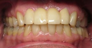 Bill Curtis's new smile makeover at Seasons of Smiles Dental