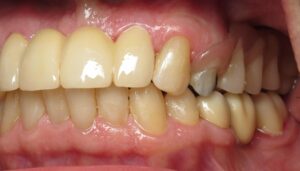 Bill Curtis's new smile makeover at Seasons of Smiles Dental