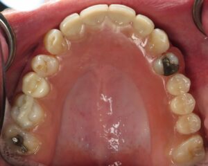 Bill Curtis's new smile makeover at Seasons of Smiles Dental