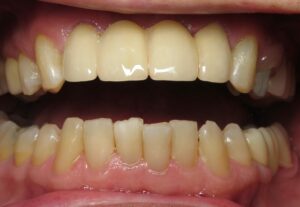 Bill Curtis's new smile makeover at Seasons of Smiles Dental
