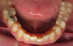 Bill Curtis's new smile makeover at Seasons of Smiles Dental