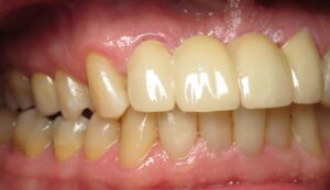 Bill Curtis's new smile makeover at Seasons of Smiles Dental