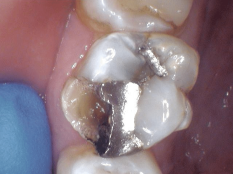 The mesial buccal cusp is broken off tooth #14.