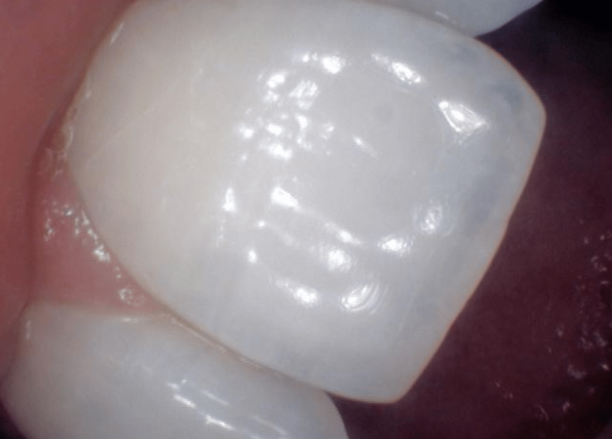 Teeth Whitening Gone Patchy