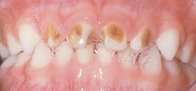 Baby Bottle Tooth Decay