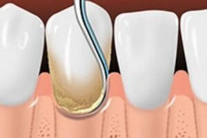 Treating Periodontal Disease