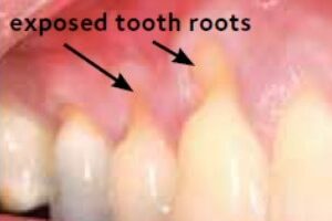 Gum Recession: Causes and Treatments