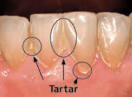 Preventing Periodontal Disease