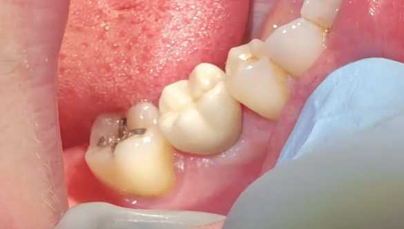 Dental Implants in Mid Coast Maine: Brenda’s Story