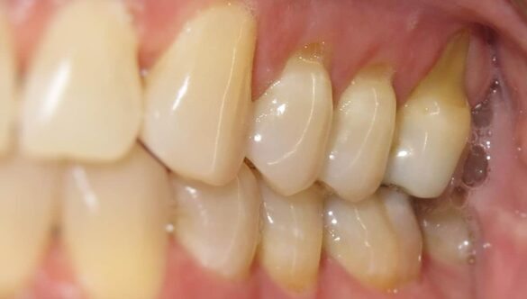 Gum Recession: It’s About More Than Just Brushing Too Hard