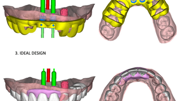 Benefits of Computer-Guided Implant Placement