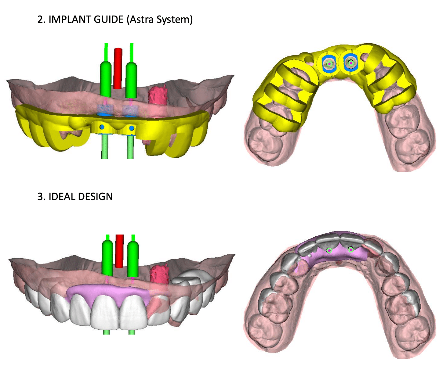 Benefits of Computer-Guided Implant Placement - Seasons of Smiles