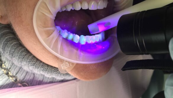 Removing Invisalign Buttons the Right Way
