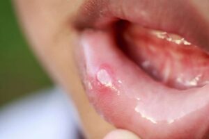 Canker Sore Remedies Explored by Your Camden Dentist