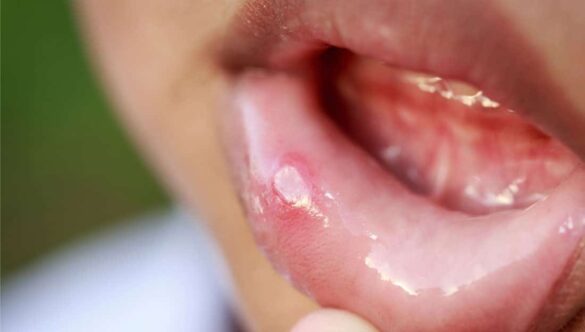 Canker Sore Remedies Explored by Your Camden Dentist