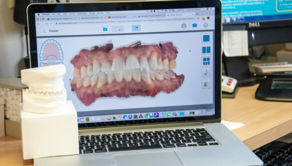 STL files vs Alginate Impressions