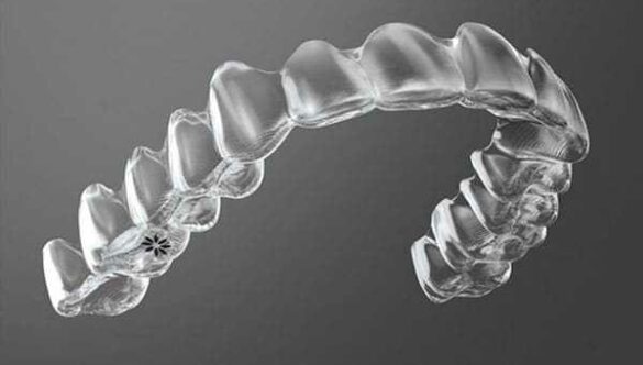 What Is Invisalign’s SmartTrack Material?