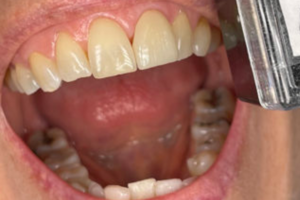 What are the best esthetic dental crown materials options? 2021