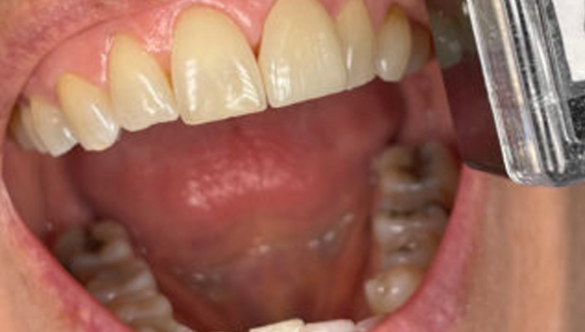 What are the best esthetic dental crown materials options? 2021