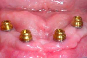 LOCATOR Abutments: Simplifying Overdentures