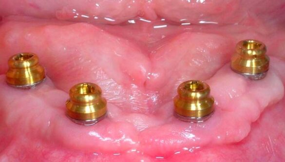 LOCATOR Abutments: Simplifying Overdentures
