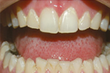 boca