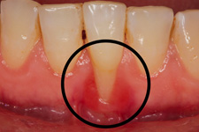 gum
