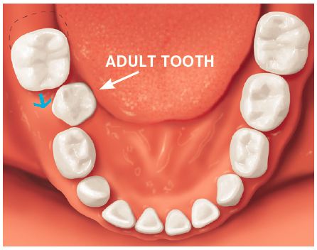 If a baby tooth is lost too early, the teeth beside it may drift into the empty space.