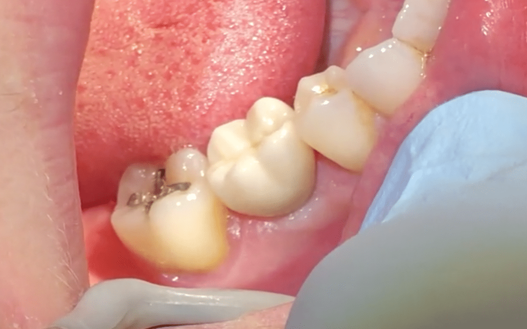 Dental Implants at Seasons of Smiles, Midcoast Maine