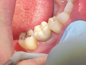 Brenda's Implant Tooth #30