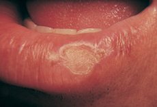 Cancer on the lip