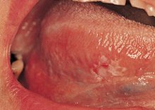 Cancer on the tongue