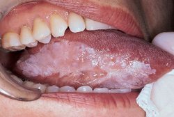 Candidiasis - PatientSmart