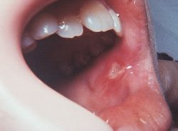 Canker Sores - PatientSmart