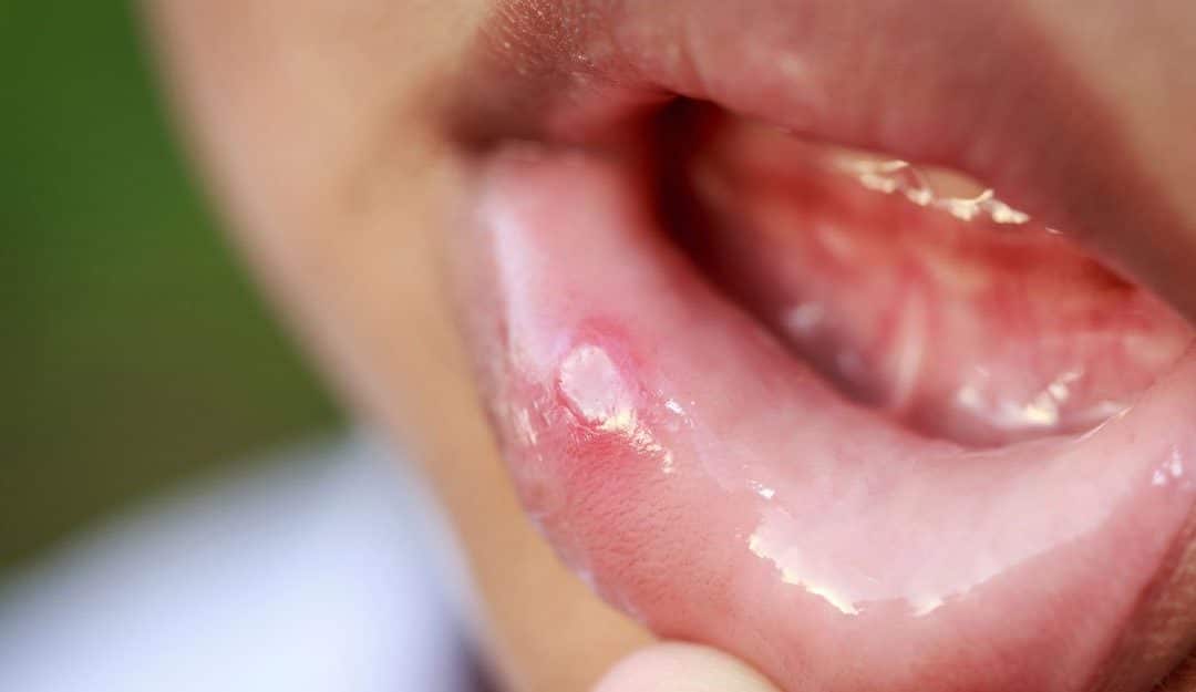 Canker Sore Remedies Explored by Your Camden Dentist