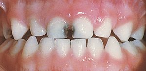 Decay in baby teeth Decay in baby teeth